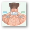 Electrode multisite ActiTENS